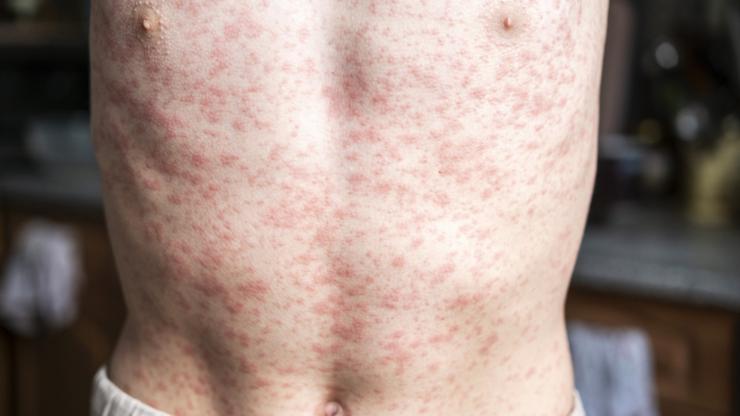 Victoria sees worst measles outbreak in a decade.